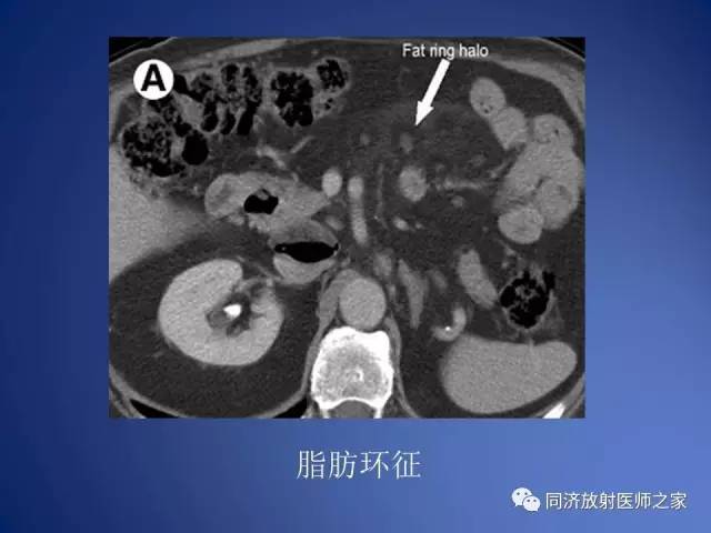 【PPT】急性原发性肠脂垂炎的CT诊断