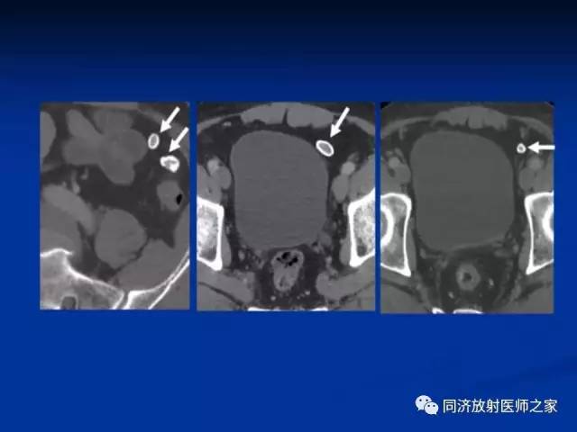 【PPT】急性原发性肠脂垂炎的CT诊断