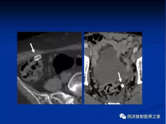 【PPT】急性原发性肠脂垂炎的CT诊断