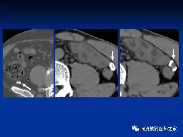 【PPT】急性原发性肠脂垂炎的CT诊断