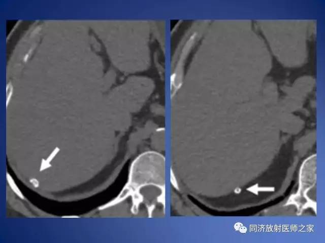 【PPT】急性原发性肠脂垂炎的CT诊断