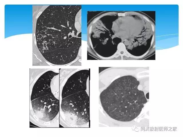 【PPT】肺实质与肺间质的梳理
