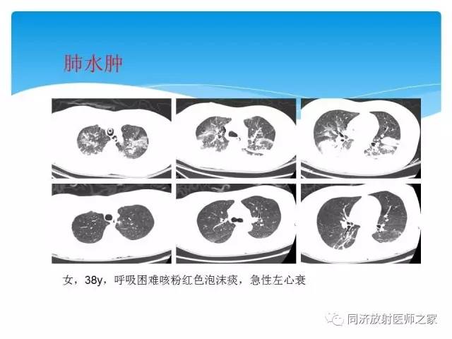 【PPT】肺实质与肺间质的梳理