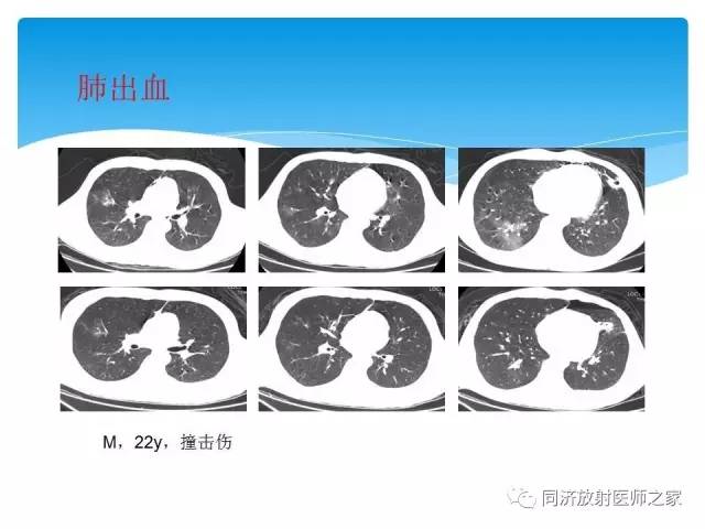 【PPT】肺实质与肺间质的梳理