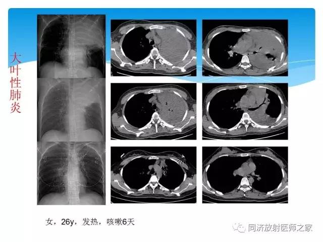 【PPT】肺实质与肺间质的梳理