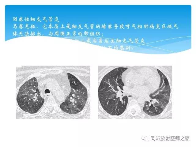 【PPT】肺实质与肺间质的梳理