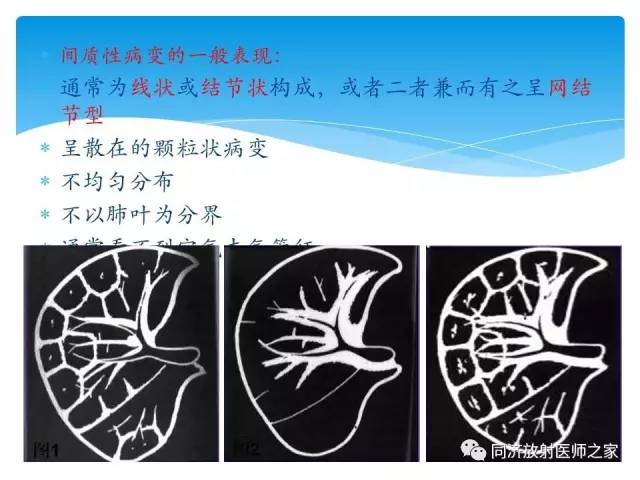【PPT】肺实质与肺间质的梳理