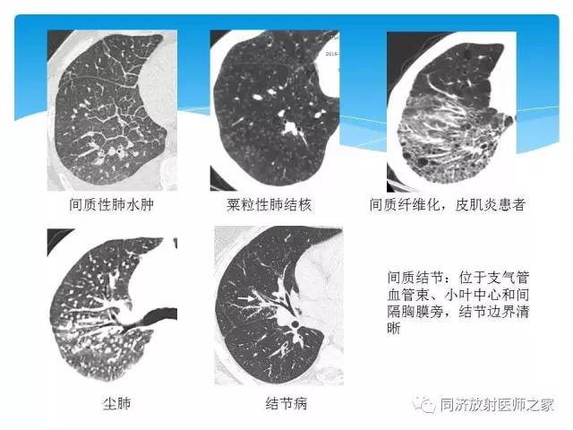 【PPT】肺实质与肺间质的梳理