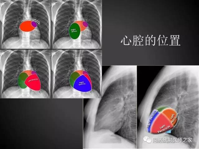 【PPT】心瓣膜病的X线和CT表现