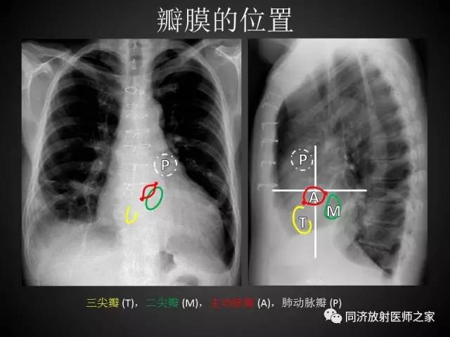 【PPT】心瓣膜病的X线和CT表现