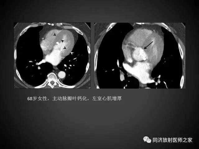 【PPT】心瓣膜病的X线和CT表现