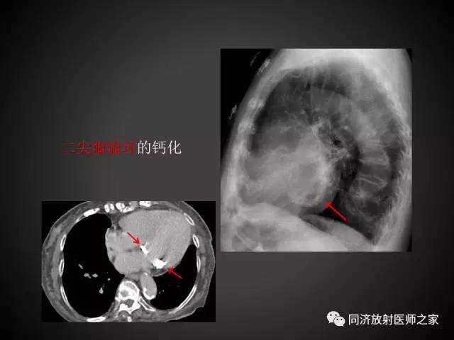 【PPT】心瓣膜病的X线和CT表现
