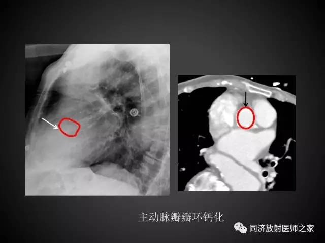 【PPT】心瓣膜病的X线和CT表现