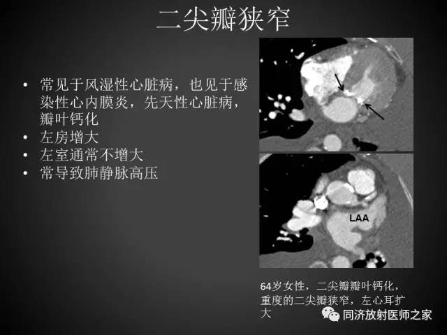 【PPT】心瓣膜病的X线和CT表现