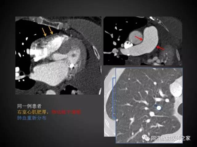 【PPT】心瓣膜病的X线和CT表现
