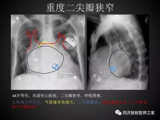 【PPT】心瓣膜病的X线和CT表现