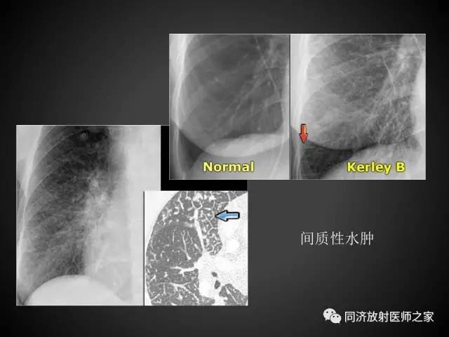【PPT】心瓣膜病的X线和CT表现