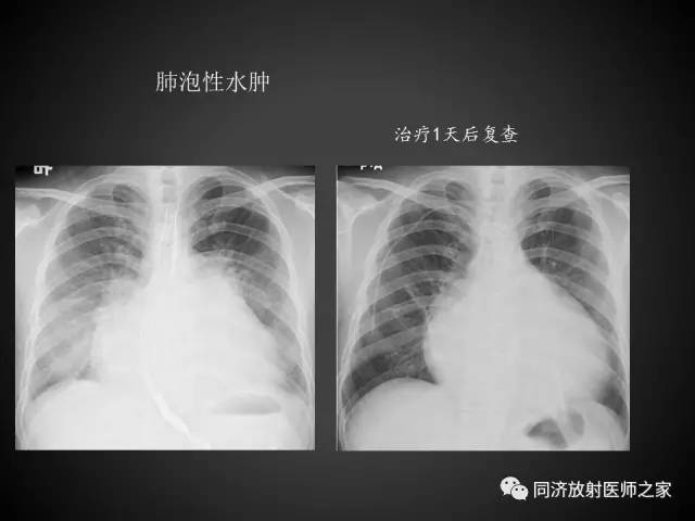 【PPT】心瓣膜病的X线和CT表现