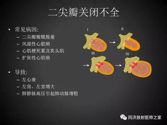 【PPT】心瓣膜病的X线和CT表现