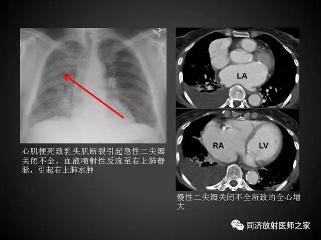 【PPT】心瓣膜病的X线和CT表现