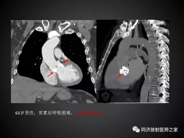 【PPT】心瓣膜病的X线和CT表现