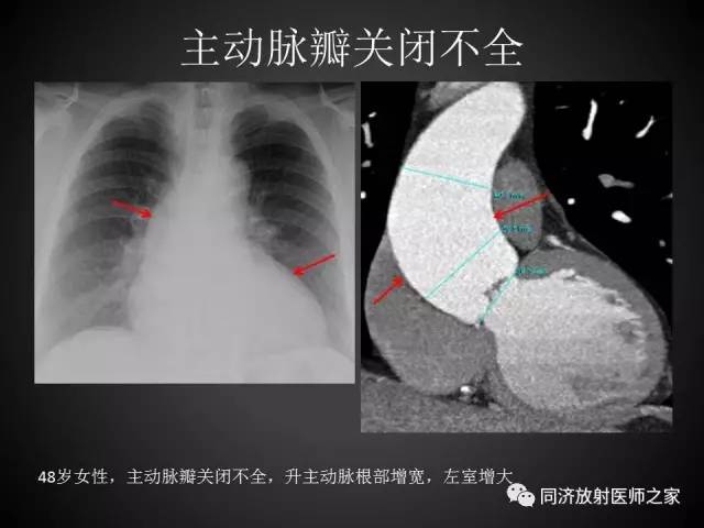 【PPT】心瓣膜病的X线和CT表现