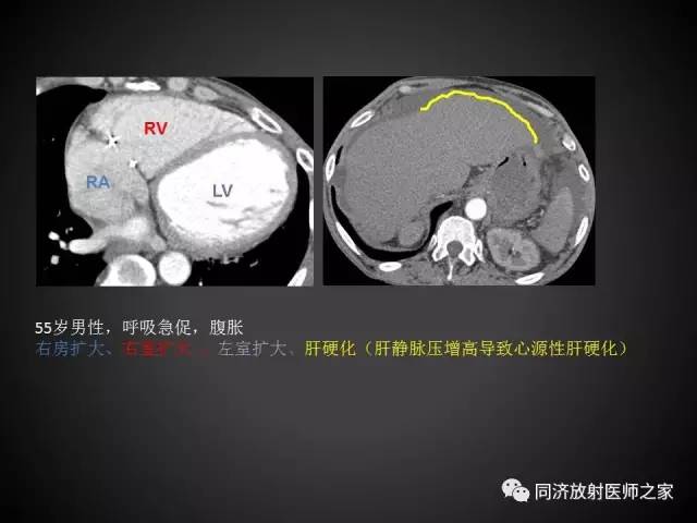 【PPT】心瓣膜病的X线和CT表现