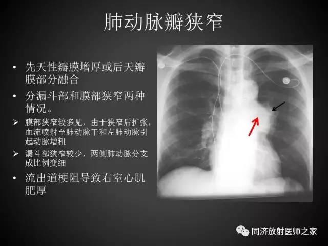 【PPT】心瓣膜病的X线和CT表现