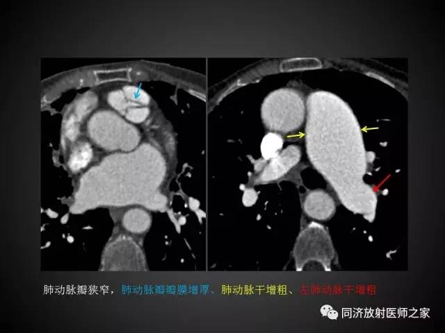 【PPT】心瓣膜病的X线和CT表现