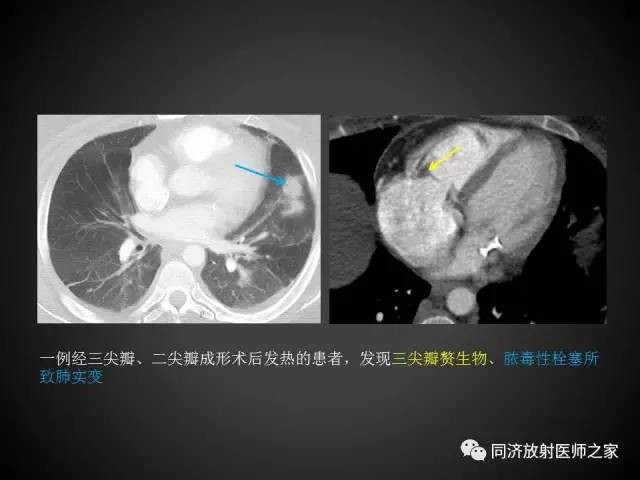 【PPT】心瓣膜病的X线和CT表现