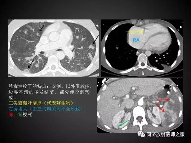 【PPT】心瓣膜病的X线和CT表现