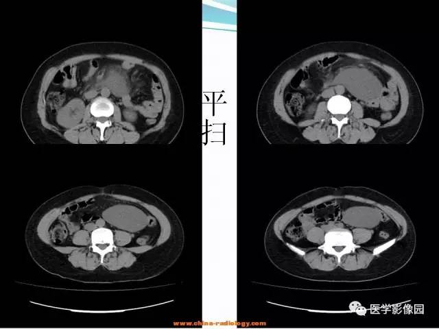 【病例】腹腔内粘液型脂肪肉瘤1例CT影像表现 【病例】腹腔内粘液型脂肪肉瘤1例CT影像表现