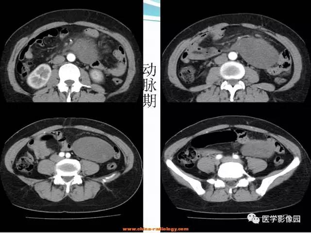 【病例】腹腔内粘液型脂肪肉瘤1例CT影像表现 【病例】腹腔内粘液型脂肪肉瘤1例CT影像表现