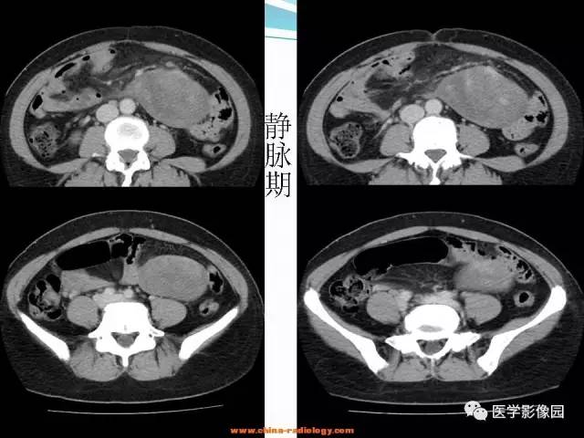 【病例】腹腔内粘液型脂肪肉瘤1例CT影像表现 【病例】腹腔内粘液型脂肪肉瘤1例CT影像表现