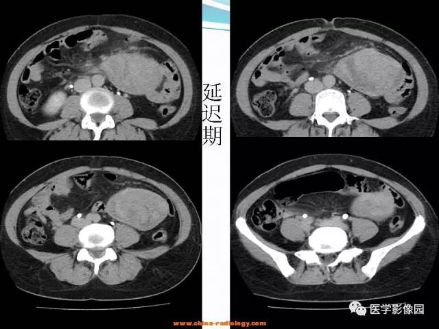 【病例】腹腔内粘液型脂肪肉瘤1例CT影像表现 【病例】腹腔内粘液型脂肪肉瘤1例CT影像表现