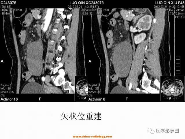 【病例】腹腔内粘液型脂肪肉瘤1例CT影像表现 【病例】腹腔内粘液型脂肪肉瘤1例CT影像表现