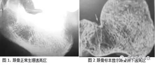发生在跟骨生理性三角透亮区的几种病变 发生在跟骨生理性三角透亮区的几种病变