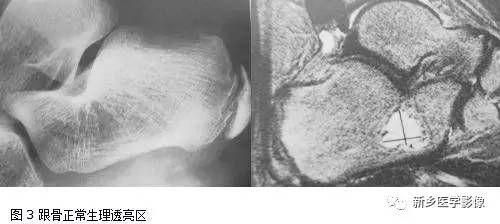 发生在跟骨生理性三角透亮区的几种病变 发生在跟骨生理性三角透亮区的几种病变