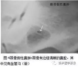 发生在跟骨生理性三角透亮区的几种病变 发生在跟骨生理性三角透亮区的几种病变