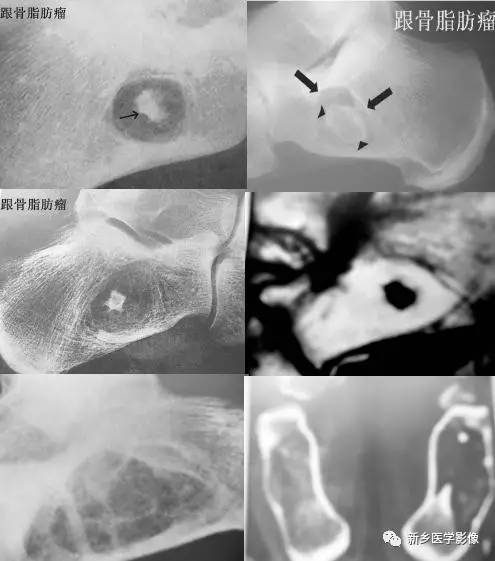 发生在跟骨生理性三角透亮区的几种病变