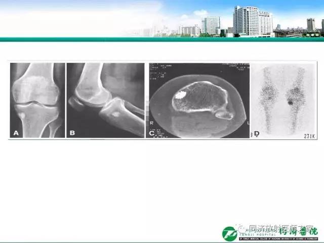 【PPT】常见肋骨良性肿瘤及肿瘤样病变的影像诊断