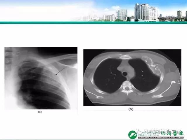 【PPT】常见肋骨良性肿瘤及肿瘤样病变的影像诊断