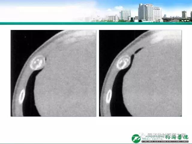 【PPT】常见肋骨良性肿瘤及肿瘤样病变的影像诊断