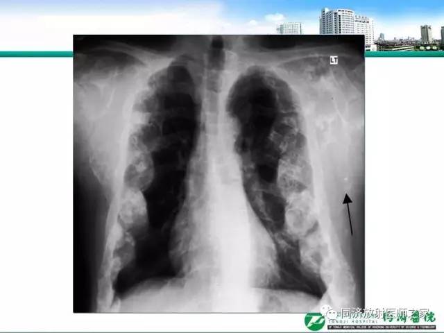 【PPT】常见肋骨良性肿瘤及肿瘤样病变的影像诊断