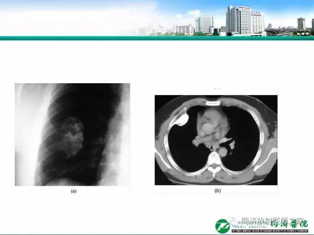 【PPT】常见肋骨良性肿瘤及肿瘤样病变的影像诊断