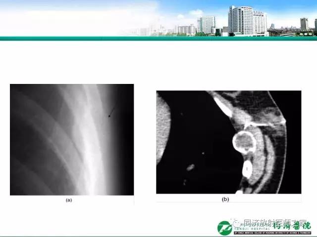 【PPT】常见肋骨良性肿瘤及肿瘤样病变的影像诊断