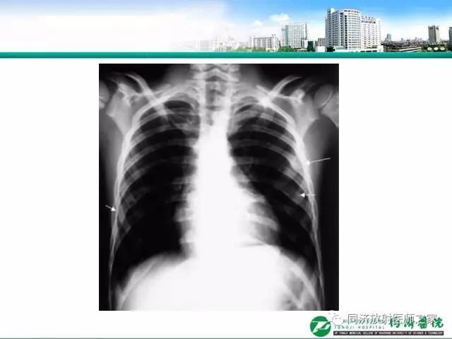 【PPT】常见肋骨良性肿瘤及肿瘤样病变的影像诊断