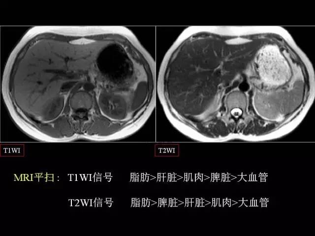 【PPT】肝脏解剖与常见变异