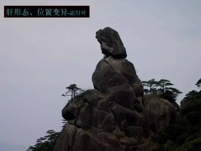【PPT】肝脏解剖与常见变异