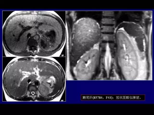 【PPT】肝脏解剖与常见变异